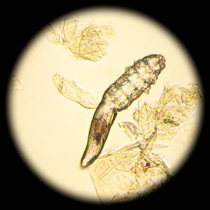 У пациентов с розацеа чаще диагностируется клещ Demodex У пациентов с розацеа чаще диагностируется клещ Demodex