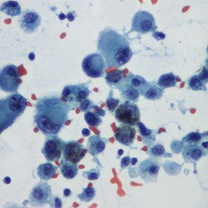 FDA выдала заключение к ImmunoPulse IL-12 для лечения меланомы FDA выдала заключение к ImmunoPulse IL-12 для лечения меланомы
