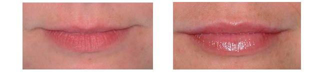 Коррекция губ препаратом Stylage Special Lips + Lidocaine Коррекция губ препаратом Stylage Special Lips + Lidocaine