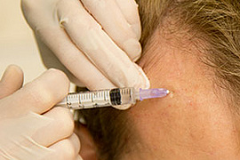 Применение мезотерапевтического метода коррекции выпадения волос