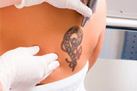 Удаление татуировок грозит раком кожи