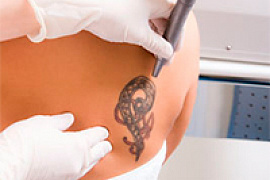 С татуировками, шрамами и растяжками справится новый лазер