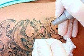 Удаление татуировки лазером может оказаться губительным