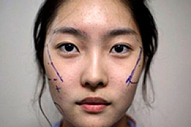 Пациенты южнокорейских пластических хирургов меняются до неузнаваемости