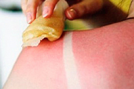 Пять солнечных ожогов в разы повышают риск рака кожи 