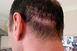 Шрамы и лысина как результат пересадки волос 