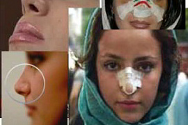 Пластика под запретом для иранских актеров 