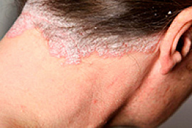Псориаз кожи волосистой части головы