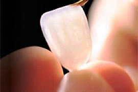 Виниры могут привести к потере зубов 