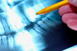 Восстановление зубов с помощью стволовых клеток