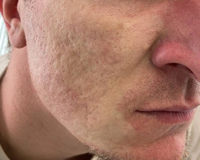 Capello Re:Flex CO₂