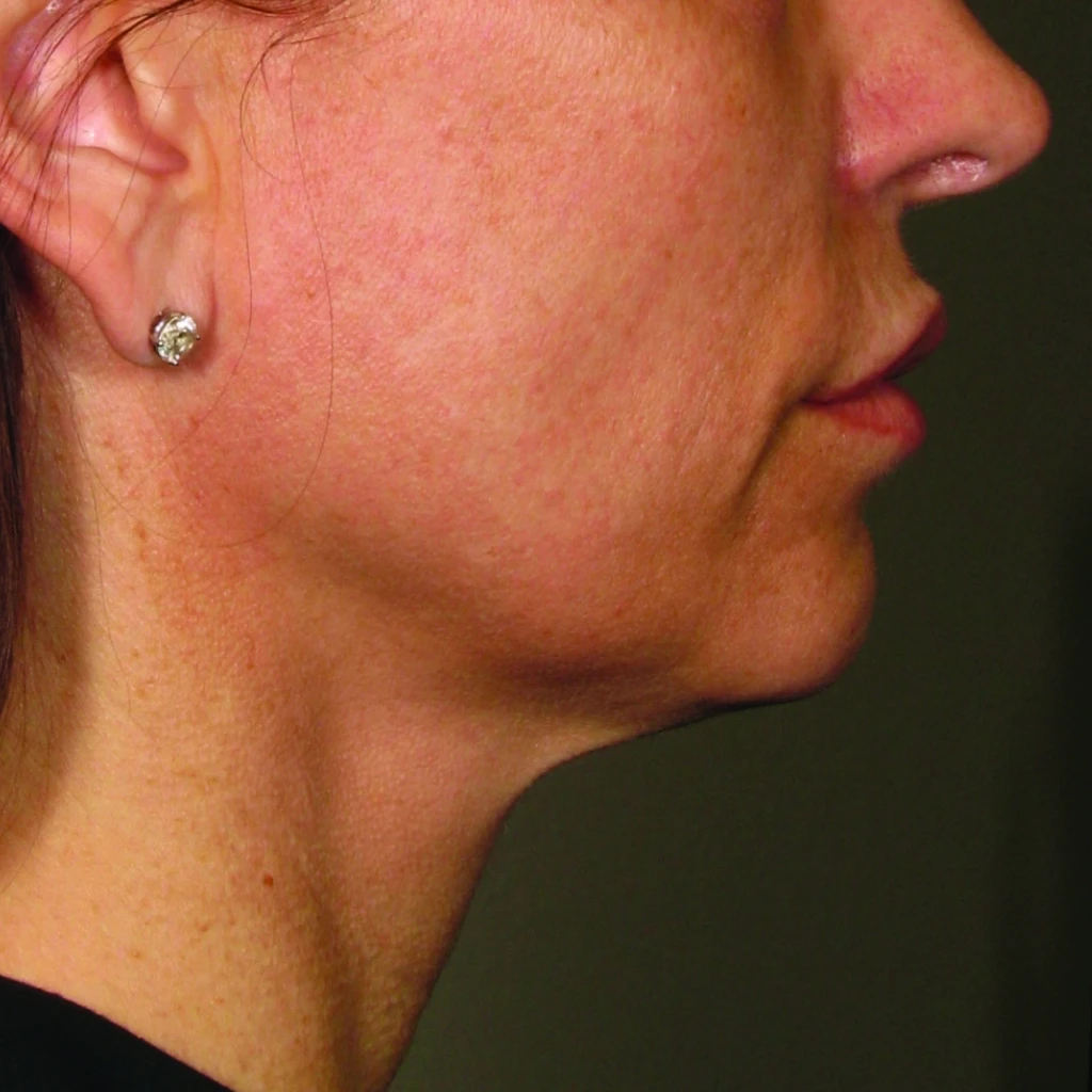 Ultherapy После
