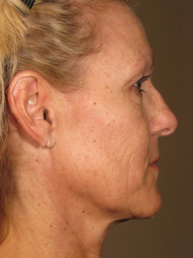 Ultherapy После