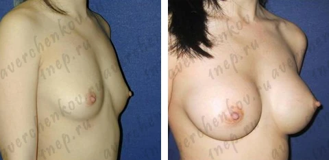 Эндоскопическое увеличение груди. Каплевидный имплант объемом 290 сс, подмышечный доступ, расположение импланта под большой грудной мышцей