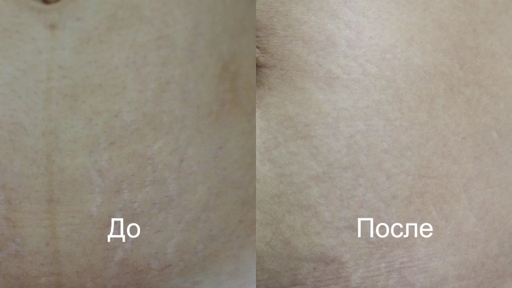 Сочетанная схема коррекции стрий