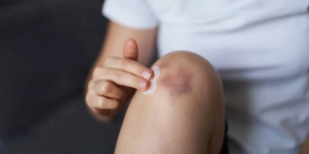 как лечить синяк