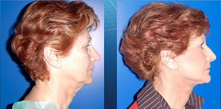 лигатурный лифтинг до и после, лигатурный лифтинг