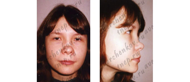 полный дефект спинки носа