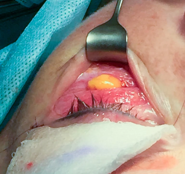 Пролоббированная часть подглазничного жирового пакета до резекции