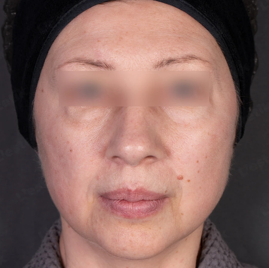 Ashley и Peach Peel PRO: До протокола