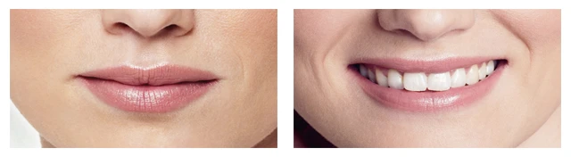  линии Риккетса, красивая улыбка