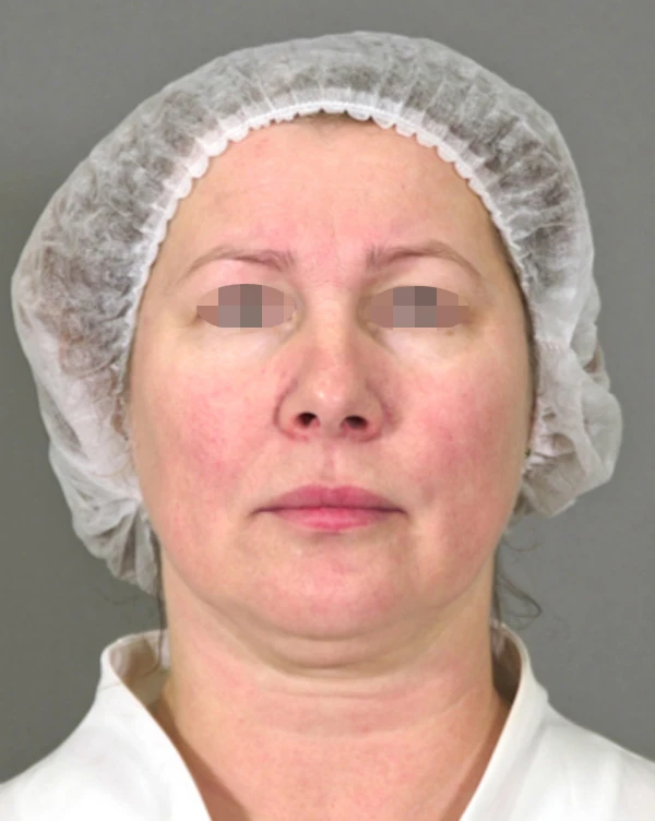 Ксеомин, фото До