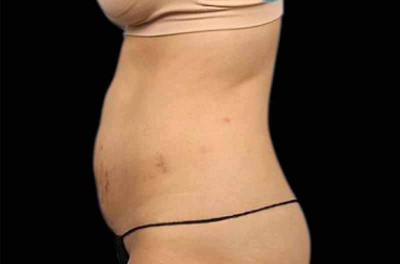 Фото до процедур на аппарате EMSCULPT