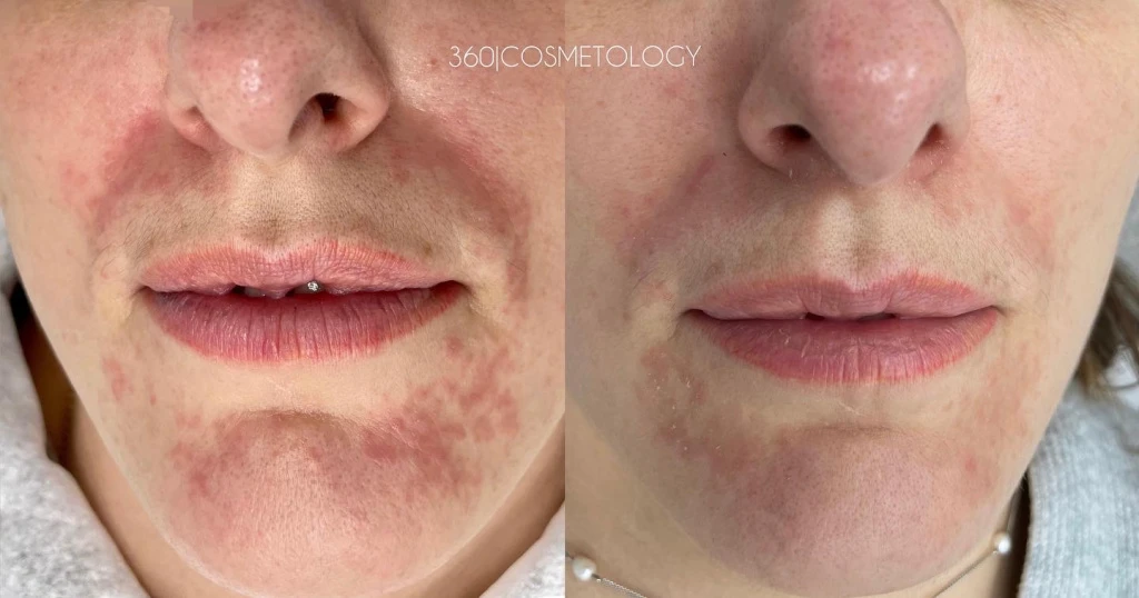 терапия HELEO4™