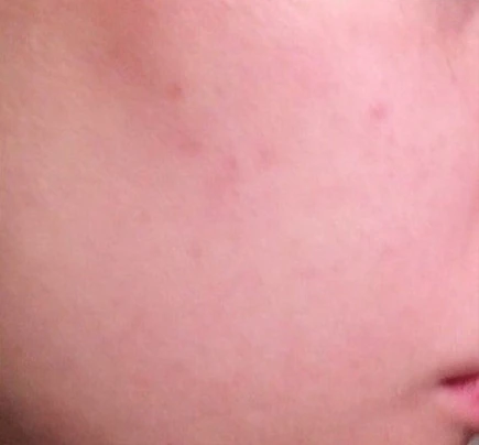 Acless spot peel