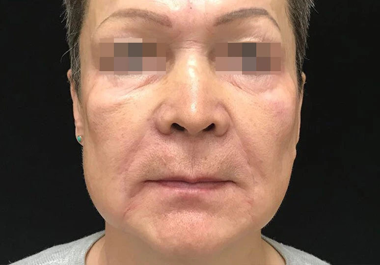 Сочетанное применение Ultherapy и инъекционной коррекции