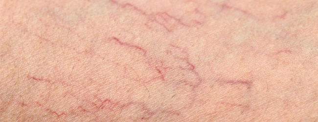 Виды сосудистых образований