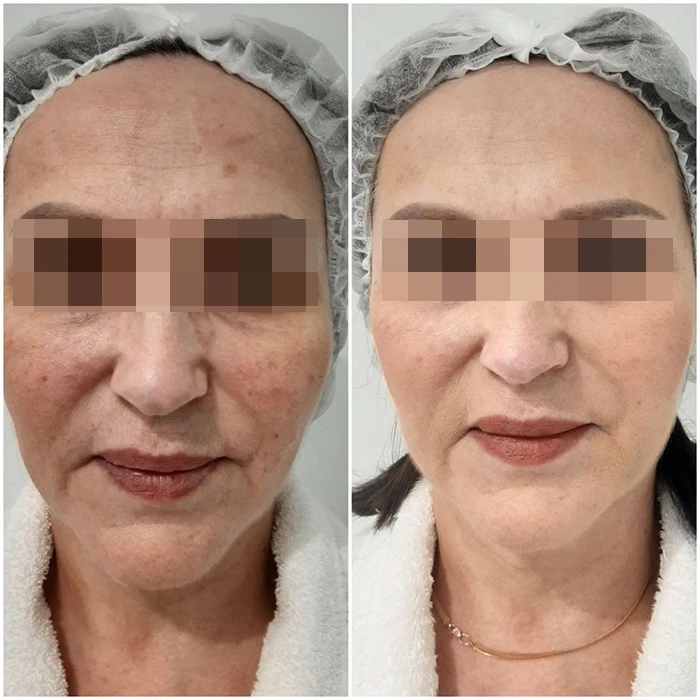 Hyalual 2,2 % и Perfoskin Complex. Фото до и после