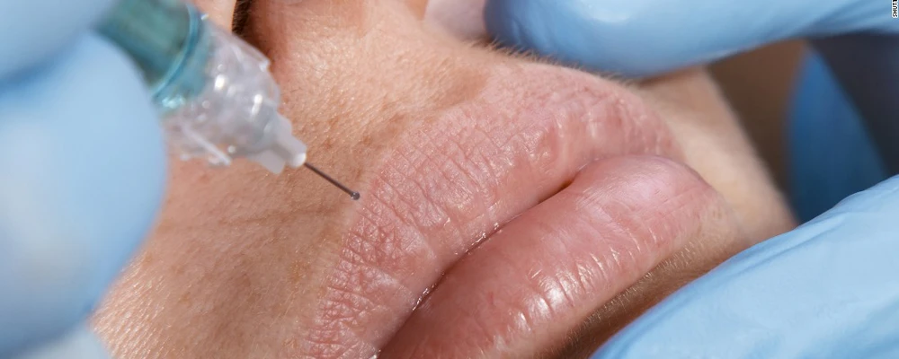 Биопленки при введении филлеров