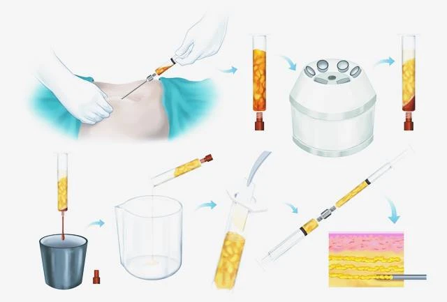 Что такое липофилинг, схема процедуры