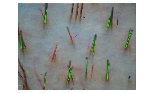 Затылочная зона на фототрихограмма при диффузном выпадении волос 