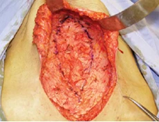 расхождение прямых мышц живота