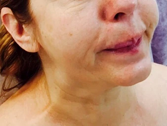 Ксеомин, Морщины марионетки