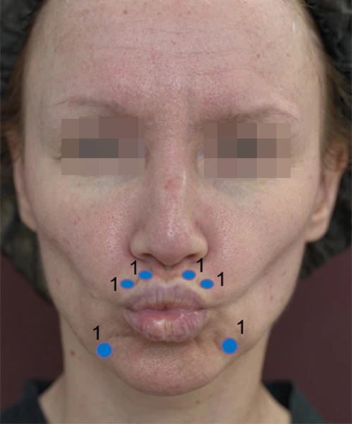 Коррекция препаратом Belotero