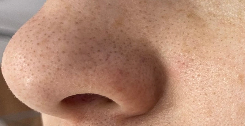 Водородный гидропилинг Hydra Touch H2