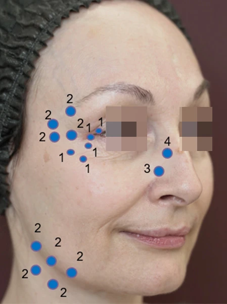 Разметка для введения препарата Ксеомин