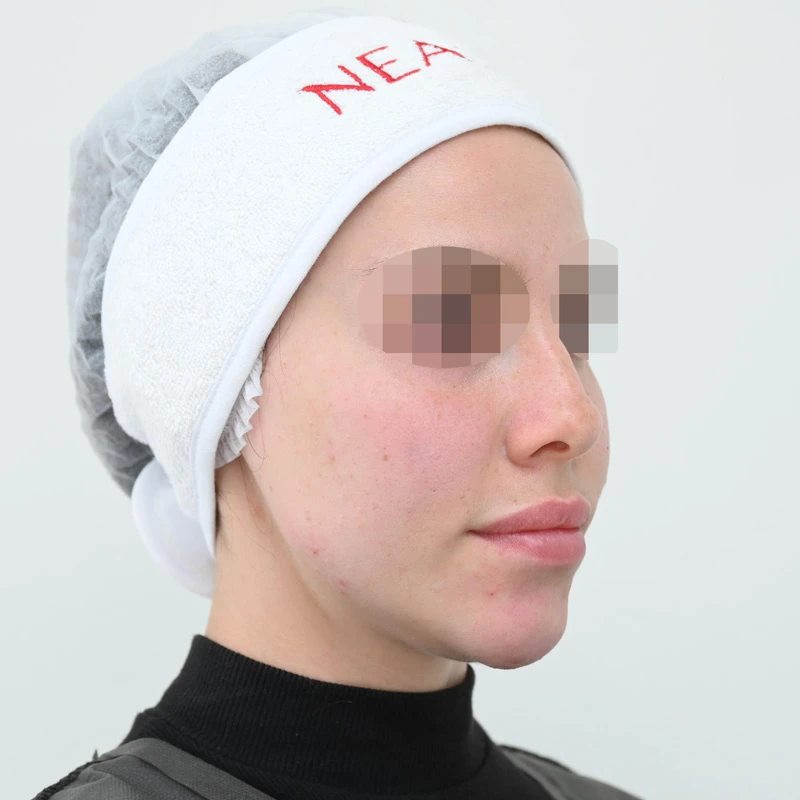 Процедура Fresh&Lift, фото после