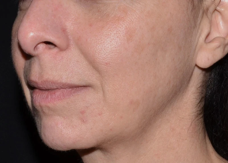 LaseMD Ultra // После процедуры