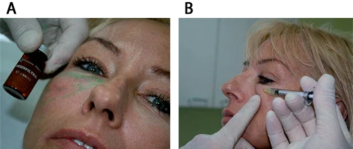 Препараты гиалуронидазы