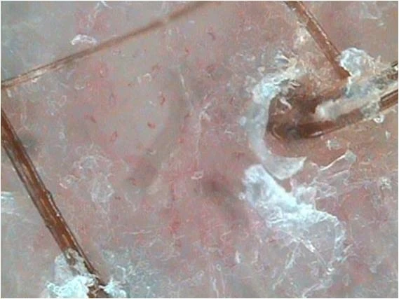 Себорейный дерматит