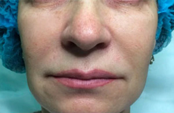 Контурная пластика против малярных мешков