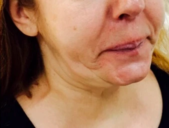 Ксеомин, Морщины марионетки