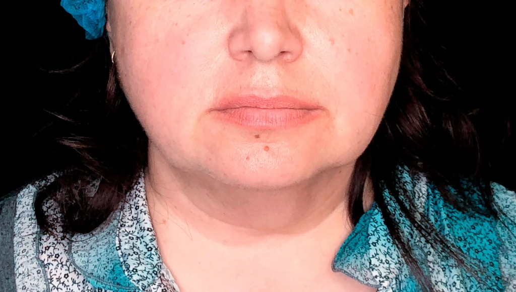 Применение Ultherapy