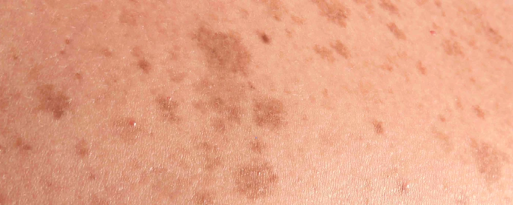 Гиперпигментация