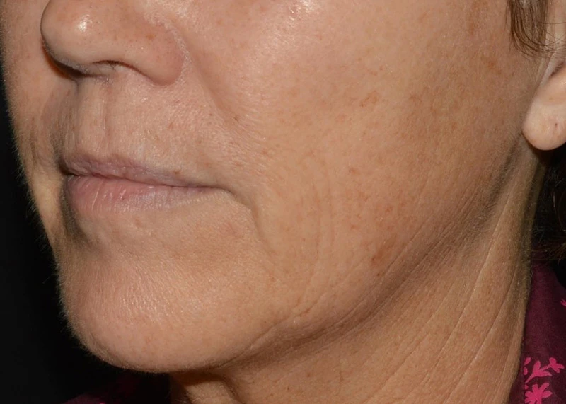 LaseMD Ultra // До процедуры