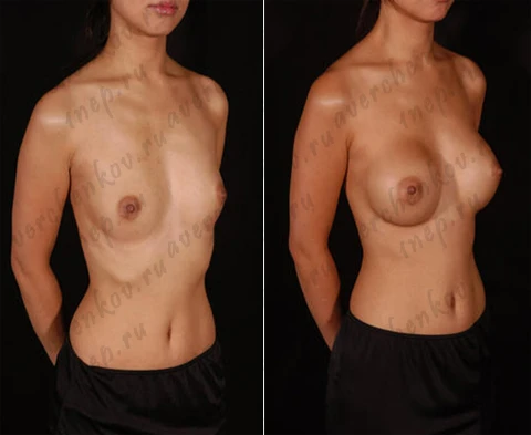 Эндоскопическая маммопластика. Круглый имплант объемом 280 сс, доступ подмышечный, расположение импланта под железой